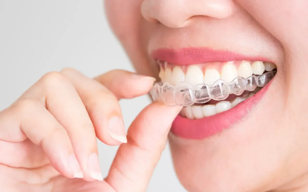 15 Facts about Invisalign You Need to Know