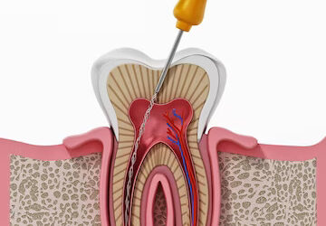 Best Root Canal treatment in Brahmand, Thane