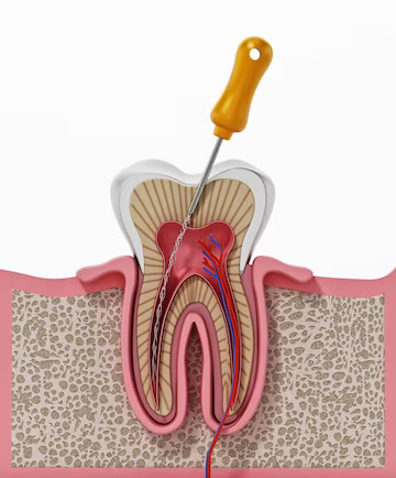 Best Root Canal treatment in Brahmand, Thane