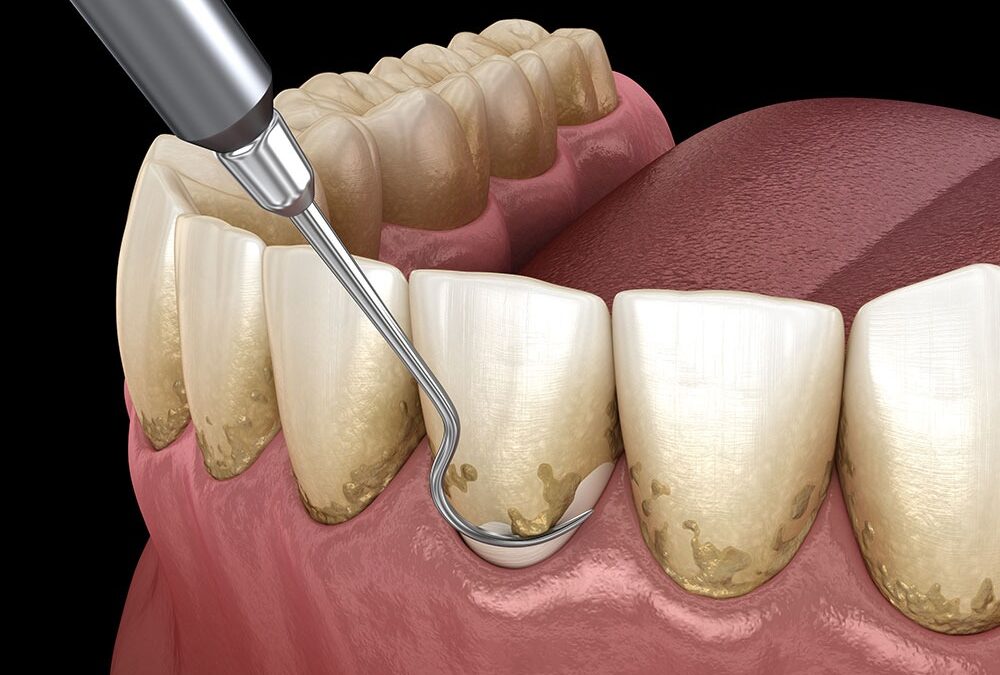 4 Myths about teeth scaling busted