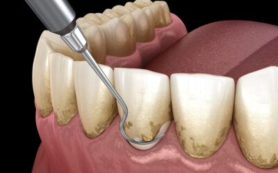 4 Myths about teeth scaling busted