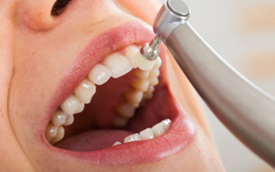 DOES DENTAL CLEANING HURT?