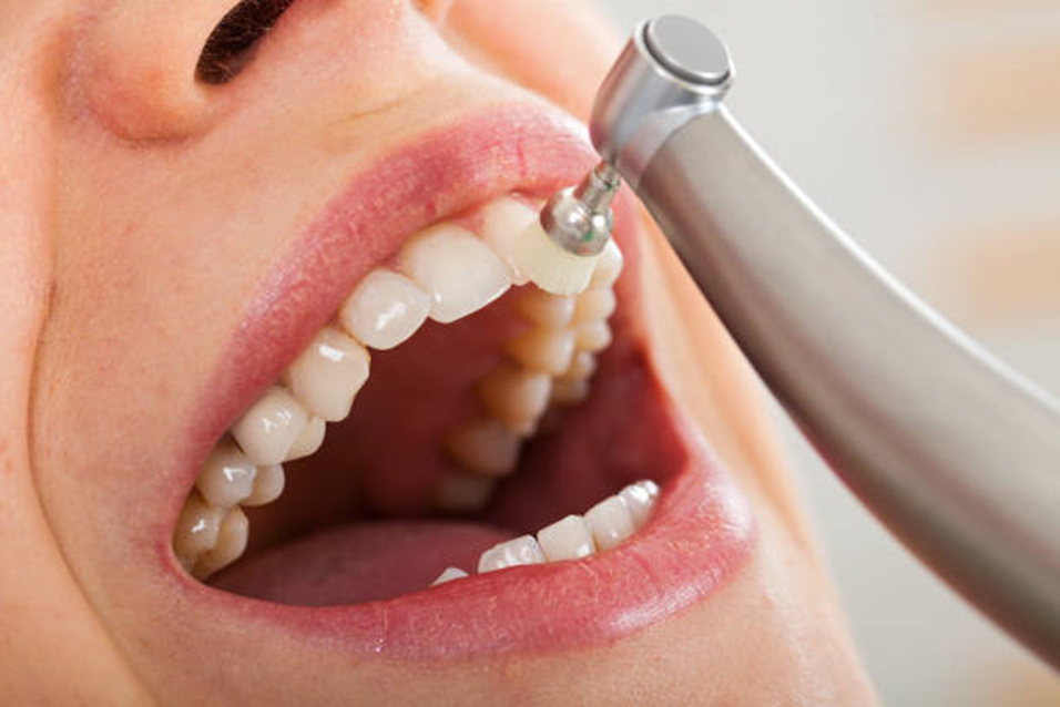 DOES DENTAL CLEANING HURT?