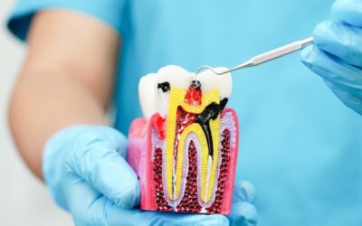 Understanding Root Canal Treatment with capping cost:  What You Need to Know