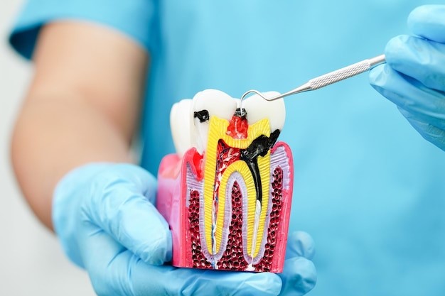 Understanding Root Canal Treatment with capping cost:  What You Need to Know